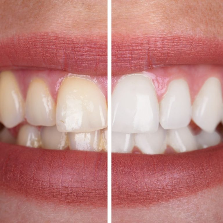 teeth whitening bellaire tx