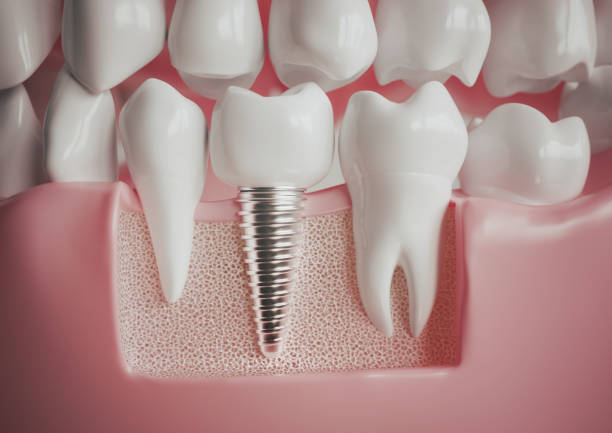 dental implant - restorative dentistry