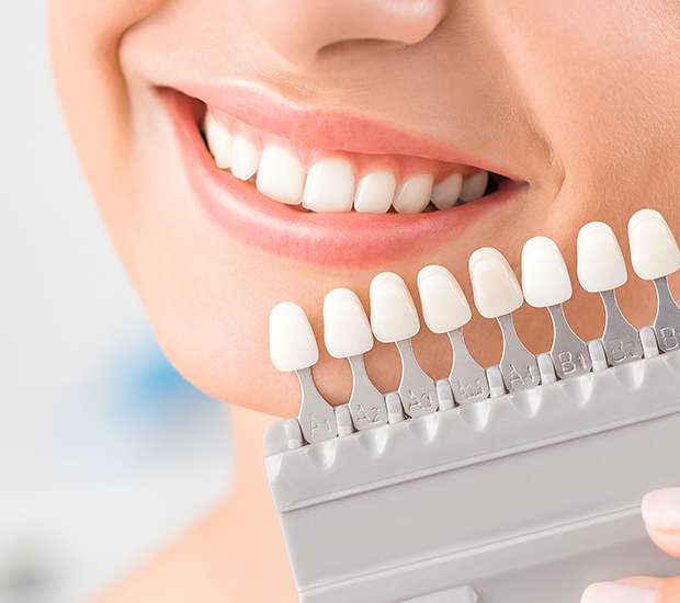 Bellaire Dental Veneers and Dental Laminates