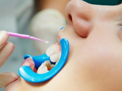 25 dental sealants in bellaire tx