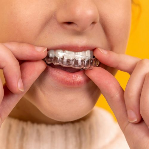 Invisalign Bellaire, TX Cost, Timeline & Why Patients Love It