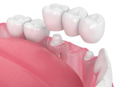 dental bridges in bellaire tx