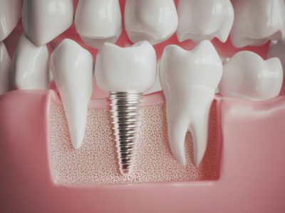 dental implant - restorative dentistry