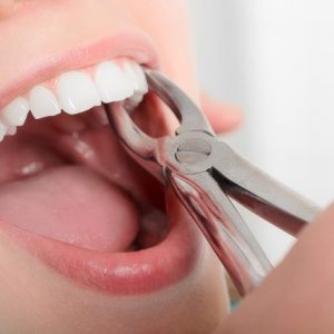 tooth extraction